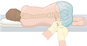 Lumbar puncture needle being placed. Illustration used with kind permission of Lymphoma Action. 