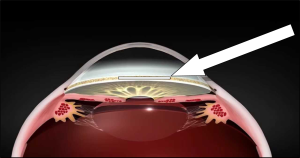 side image of the and eyeball with an arrow pointing to where the surgery will take place 