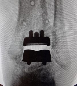 An ankle Xray