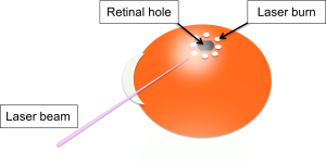 Diagram of the a laser beam pointing directly at the retinal hole creating burns around the hole. 