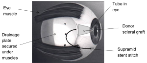 Image is a side view of an eye and where the tube is inserted.
