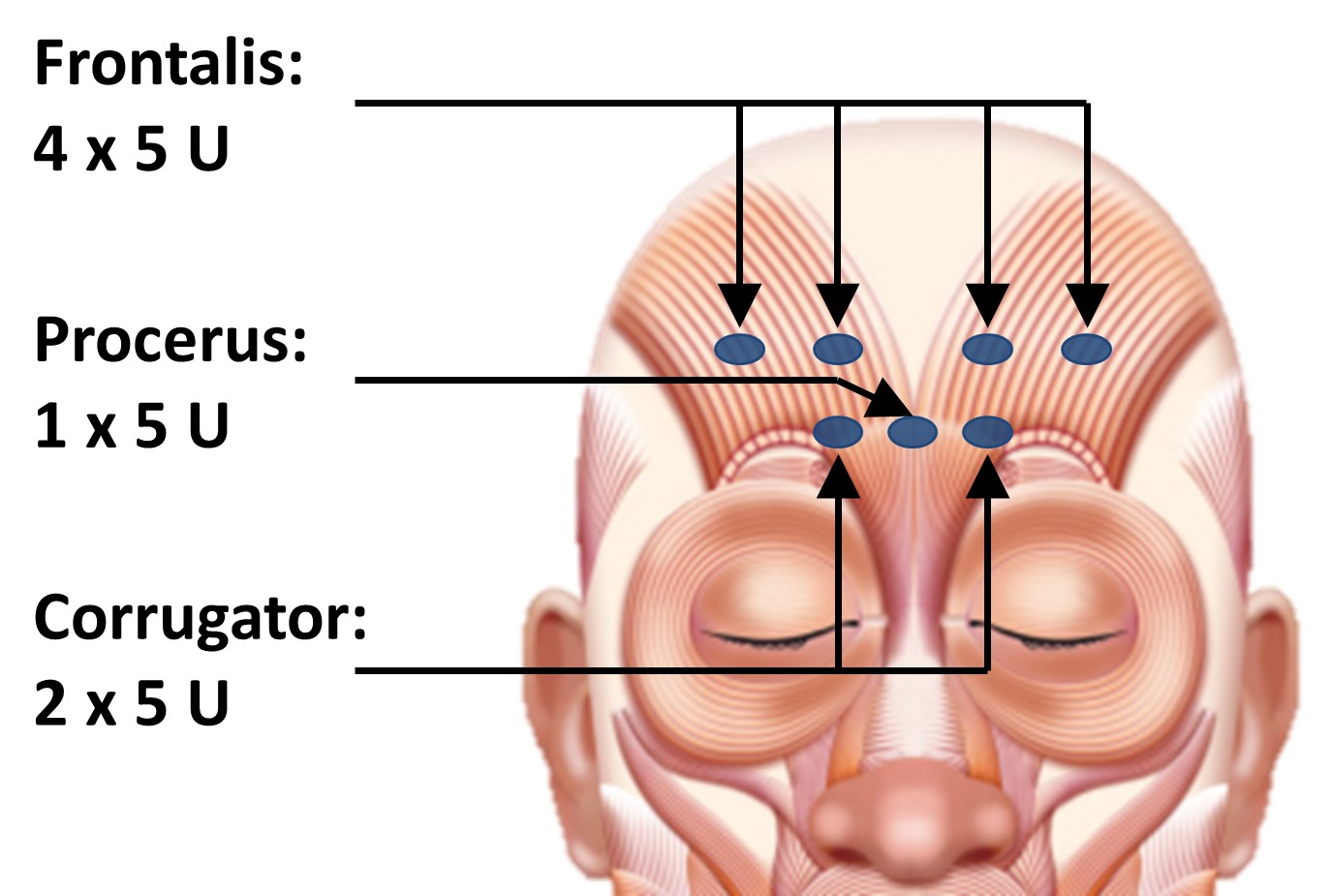 Preempt Injection Map Botox for chronic migraine - The Dudley Group NHS Foundation Trust