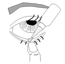 Image shows drops being administered into the lower eye lid.