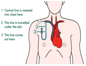 Diagram demonstrating Hickman Line insertion