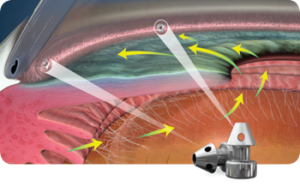 Graphic of the inside of an eye with arrows showing the direction of the drainage 