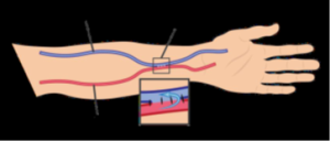 Diagram demonstrating where fistula is placed, with AV fistula in the arm.