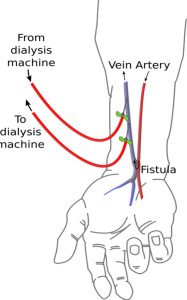 Diagram demonstrating an AV fistula being used for dialysis.