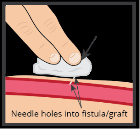 Image showing needle holes into fistula/graft.