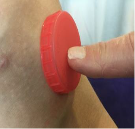 Image showing how a bottle top can help localise pressure over the bleeding site.