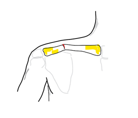 A graphic showing an outline of a collar bone. There is a yellow section which shows where the fracture occurs.