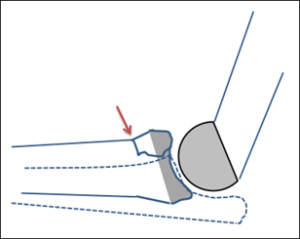 A diagram showing an elbow fracture and where it occurs on the bone.