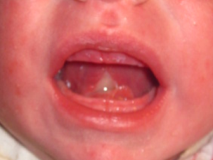 An image showing a baby's mouth after a tongue tie procedure has been performed.