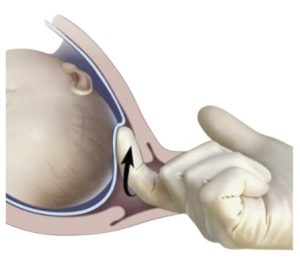 Side view of a gloved hand with a single finger being inserted through the cervix and using the finger to separate the sac of waters away from the cervix.