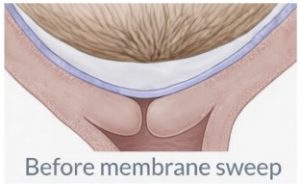 Side view of the position of the "before sweep" sac of waters closely overlying the cervix.