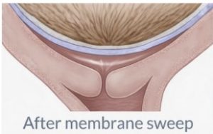 Side view of the position of the "after sweep" sac of waters having separated away from directly overlying the cervix.