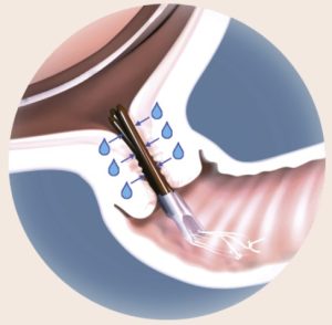An image of dilapan rods in a cervix, showing how they absorb water from the cervix.