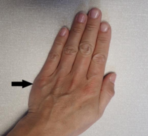Image demonstrating a hand with an arrow pointing to the fifth metacarpal area, where the break is in your hand